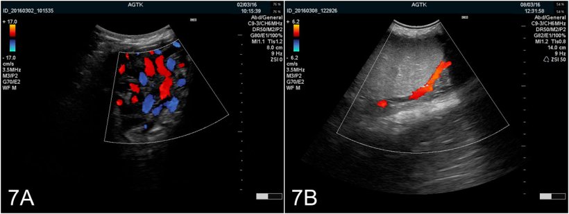 Figura 7:Imagens do test&iacute;culo obtidas mediante ultrasonografia Doppler a cores. A) Vasos do cord&atilde;o esperm&aacute;tico. B) Art&eacute;ria testicular
