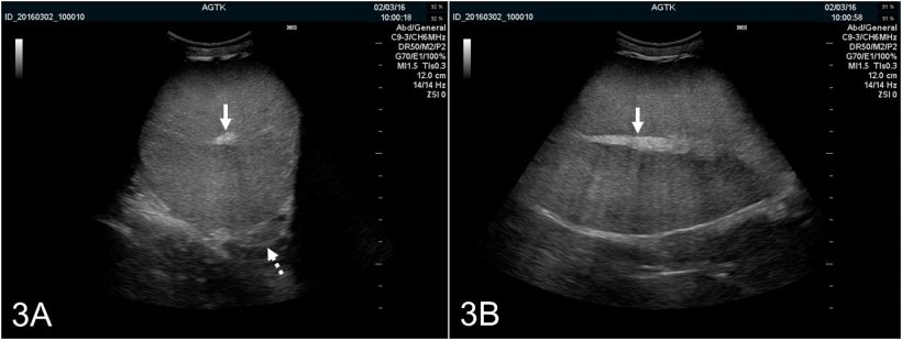 Figura 3:&nbsp;Imagens ultrasonogr&aacute;ficas do test&iacute;culo de um varrasco, ap&oacute;s recolha de s&eacute;men, transversalmente (A) e longitudinalmente (B). A rete testis &eacute; representada como uma mancha hiperecog&eacute;nica no centro do test&iacute;culo (seta s&oacute;lida). O par&ecirc;nquima testicular apresenta ecogenicidade m&eacute;dia e de ecotextura homog&eacute;nea. A imagem transversal tamb&eacute;m permite uma &oacute;ptima visualiza&ccedil;&atilde;o do corpo epididimal (seta ponteada), que &eacute; normalmente de apar&ecirc;ncia ultrasonogr&aacute;fica similar &agrave; do test&iacute;culo.
