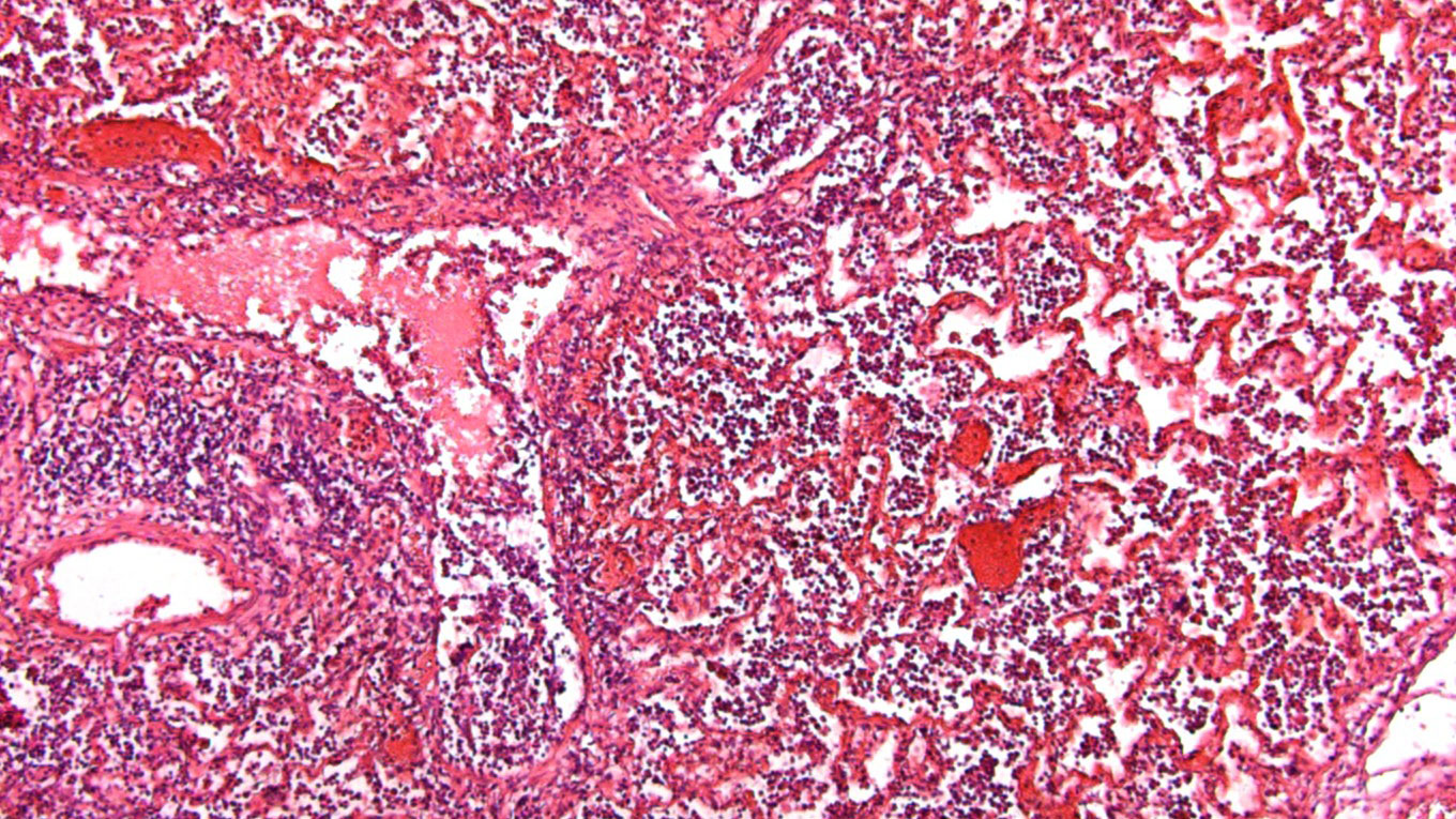 Alvéolos com acumulação de líquido e células inflamatórias