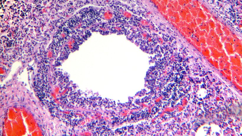Figura 4. Bronqu&iacute;olo que apresenta descama&ccedil;&atilde;o e necrose do epit&eacute;lio respirat&oacute;rio, em conjunto com uma not&oacute;ria infiltra&ccedil;&atilde;o linfoc&iacute;tica da l&acirc;mina pr&oacute;pria e sub-mucosa.
