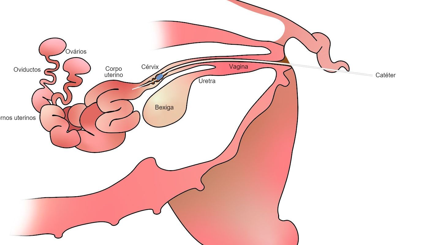 Imagem 1. Na insemina&ccedil;&atilde;o artificial p&oacute;s-cervical o s&eacute;men &eacute; depositado no corpo do &uacute;tero, depois da c&eacute;rvix
