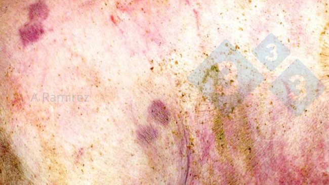 Figura 1. Lesão cutânea patognómica em forma de diamante