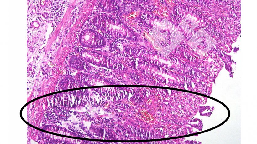 Foto 4. Trombose vascular, infarto, ulceração na mucosa do cólon.
