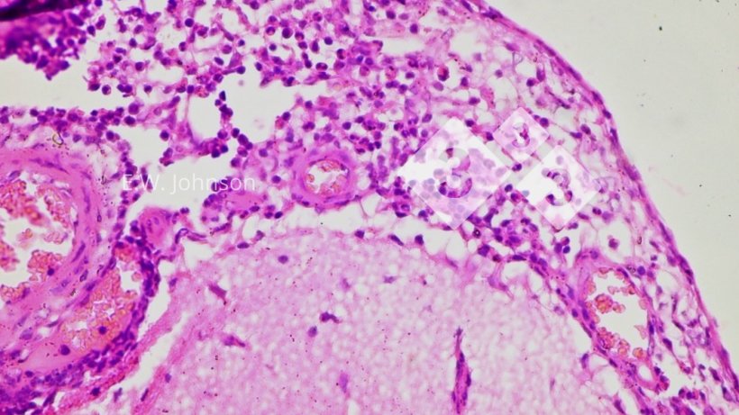 Imagem 3. Meningite com c&eacute;lulas mononucleares e algumas c&eacute;lulas polimorfonucleares. Cérebro.
