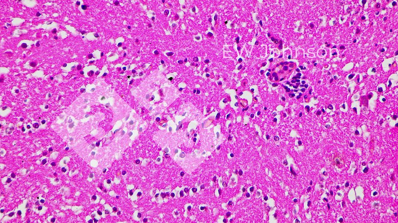 Figura 4.&nbsp;Encefalite cerebral com vasculite, satelitose e neuronofagia.
