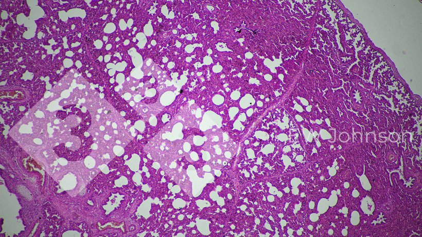 Figura 3.&nbsp;A pneumonia intersticial sugere uma possível origem viral.