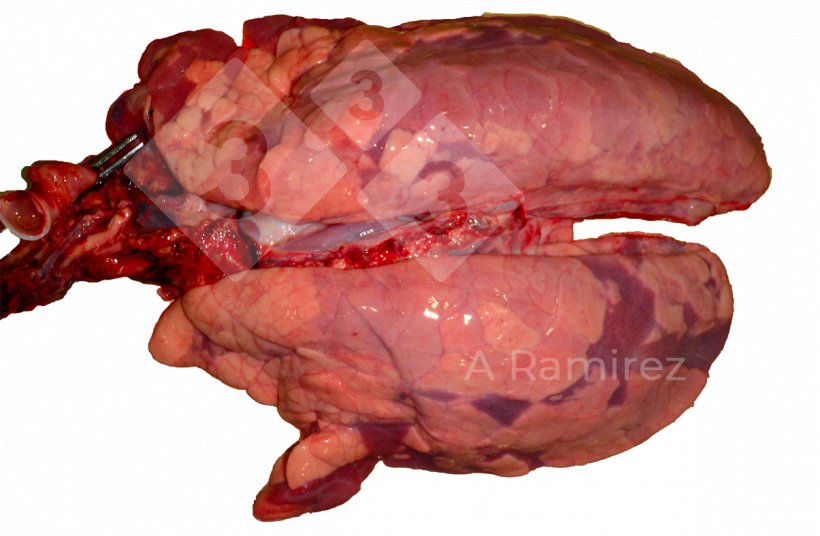 Figura 3: Infecção por gripe A de apresentação irregular e difusa com ligeiro edema interlobular.
