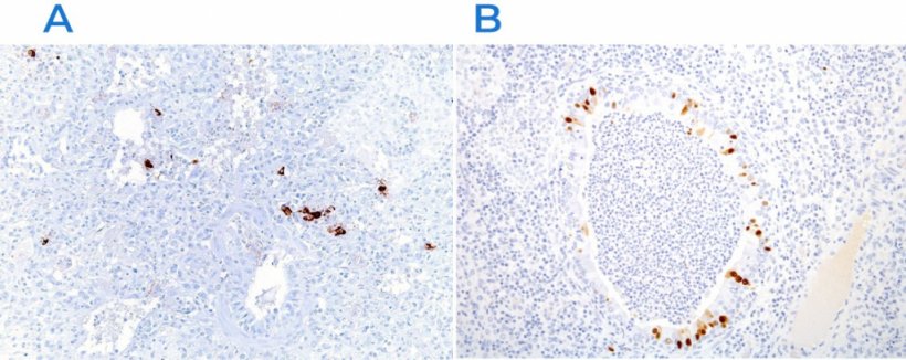 Figura 3. Inmunohistoqu&iacute;mica para detectar o vírus do s&iacute;ndrome respiratório e reprodutivo suíno (PRRSV) (A) e o vírus da gripe suína (B). A presença do antigénio vírico (corante castanho) é encontrada nas áreas afectadas.
