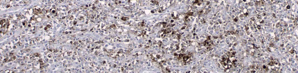 Ant&iacute;genos de PCV2 detectados por inmunohistoqu&iacute;mica