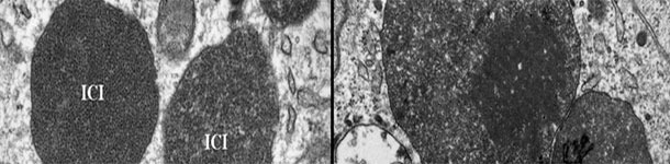 Microscop&iacute;a electr&oacute;nica de un ganglio linf&aacute;tico de un cerdo con PCV2-SD