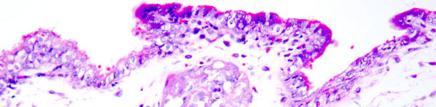 Necrosis coagulativa en trofoblastos. Tinci&oacute;n hematoxilina-eosina. 
