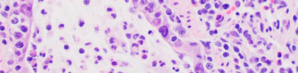 Lesiones microsc&oacute;picas compatibles con la infecci&oacute;n por influenza, incluyen necrosis del epitelio bronquiolar donde el virus se replica