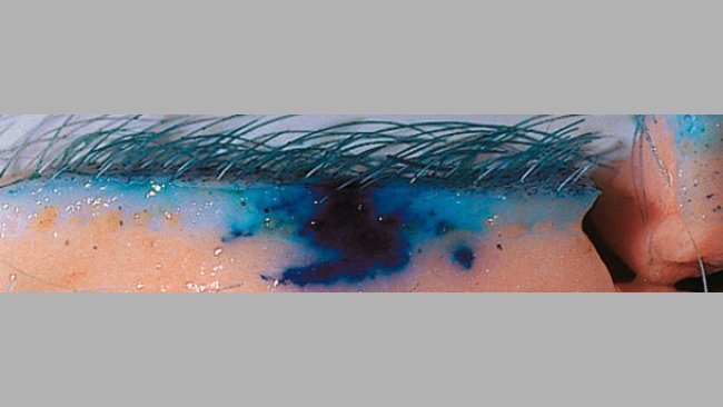 La tecnología sin aguja mejora la dispersión de las vacunas en el tejido