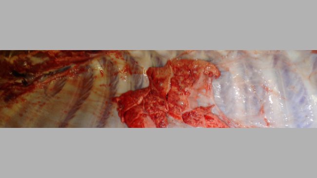 Pleuritis en pulmones